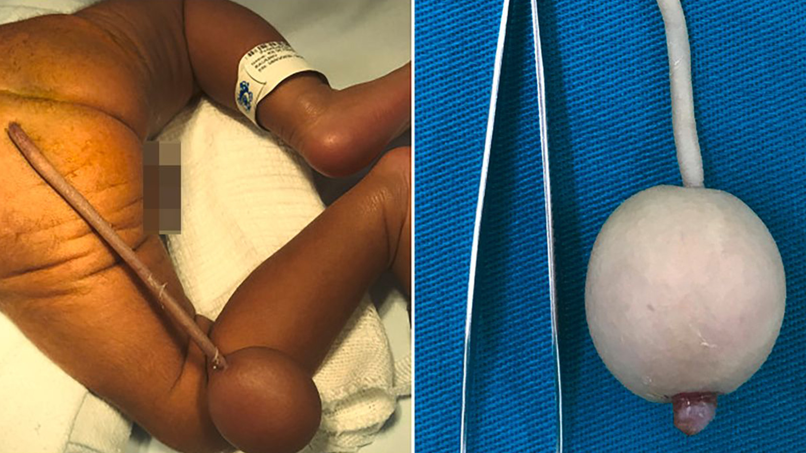 Tıp dünyası şoke oldu, doktorlar gördüklerine inanamadı! Dünyadaki 40 vakadan biri olan bebek, 12 cm kuyrukla doğdu